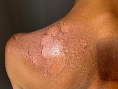 Peel back and shoulder skin from sunburn effect on young man body from sunbathing in summer