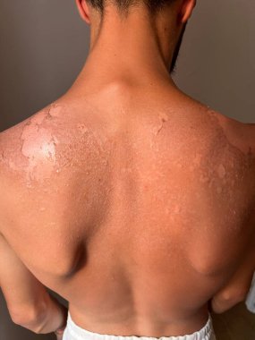 Peel back and shoulder skin from sunburn effect on young man body from sunbathing in summer