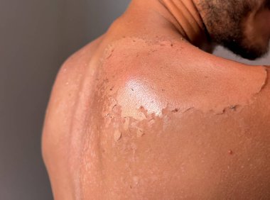 Peel back and shoulder skin from sunburn effect on young man body from sunbathing in summer