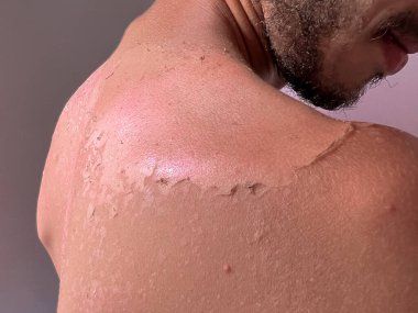 Peel back and shoulder skin from sunburn effect on young man body from sunbathing in summer