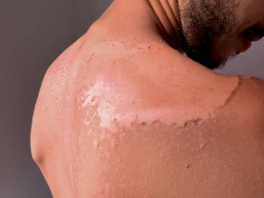 Peel back and shoulder skin from sunburn effect on young man body from sunbathing in summer