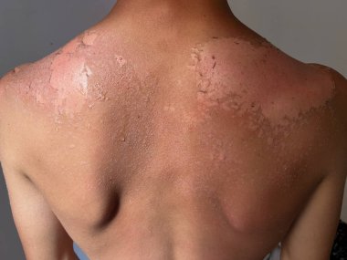 Peel back and shoulder skin from sunburn effect on young man body from sunbathing in summer