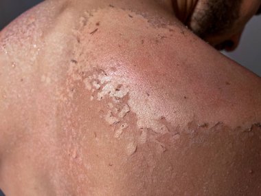 Peel back and shoulder skin from sunburn effect on young man body from sunbathing in summer