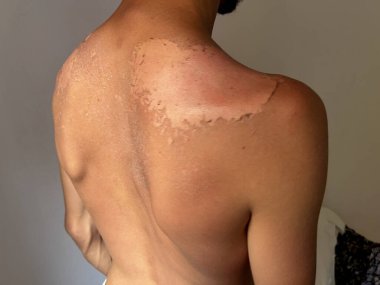 Peel back and shoulder skin from sunburn effect on young man body from sunbathing in summer