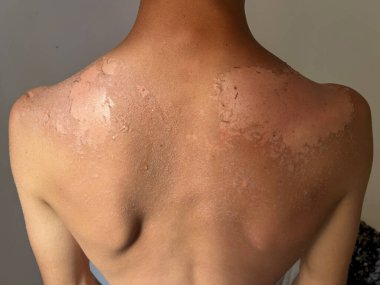 Peel back and shoulder skin from sunburn effect on young man body from sunbathing in summer