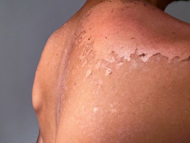 Peel back and shoulder skin from sunburn effect on young man body from sunbathing in summer