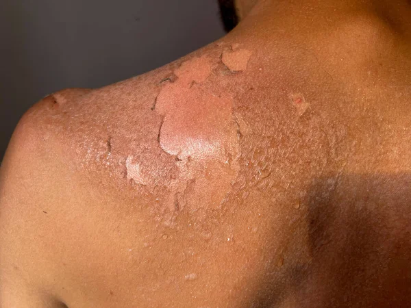 Peel back and shoulder skin from sunburn effect on young man body from sunbathing in summer