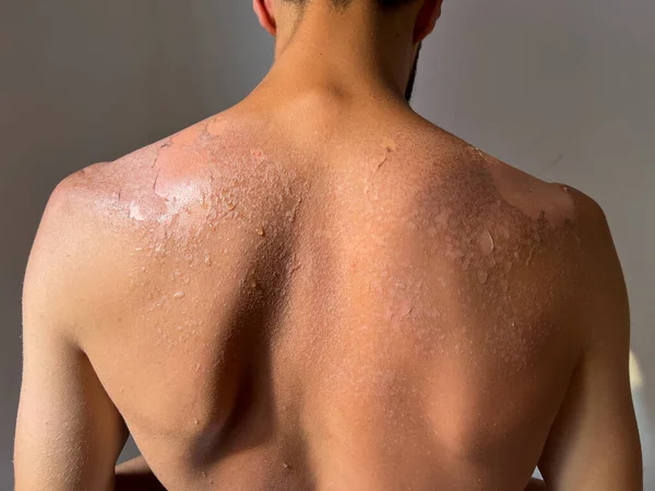 Peel Back Shoulder Skin Sunburn Effect Young Man Body Sunbathing — стоковое фото