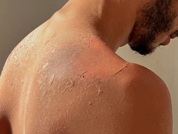 Peel Back Shoulder Skin Sunburn Effect Young Man Body Sunbathing — Φωτογραφία Αρχείου