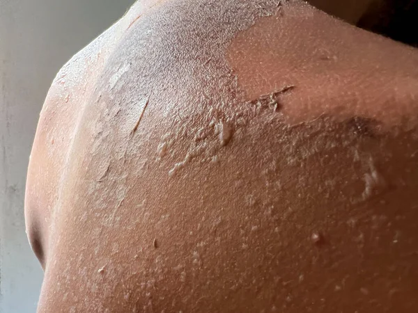 Güneş Yanığı Tenini Omuzlarını Yaz Aylarında Güneş Banyosu Yapan Genç — Stok fotoğraf
