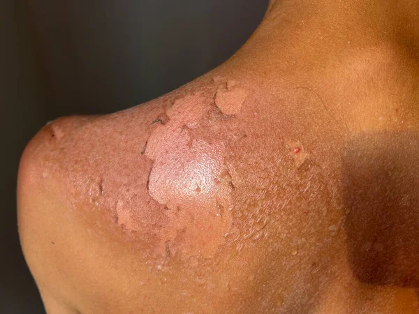 Peel back and shoulder skin from sunburn effect on young man body from sunbathing in summer