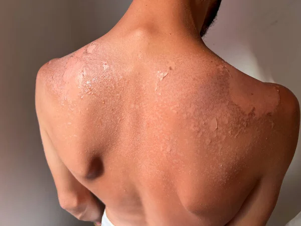 Peel back and shoulder skin from sunburn effect on young man body from sunbathing in summer