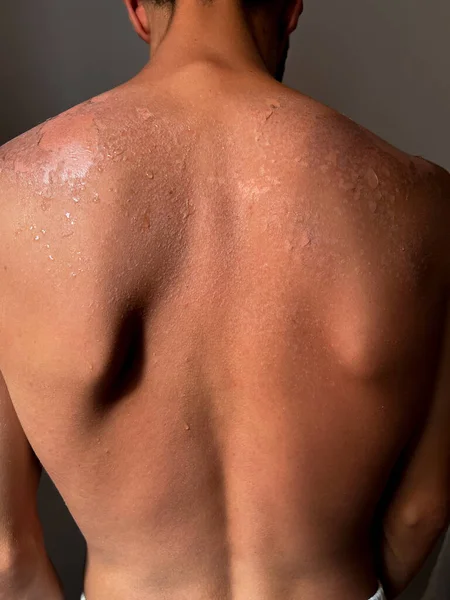 Peel Back Shoulder Skin Sunburn Effect Young Man Body Sunbathing — Stockfoto