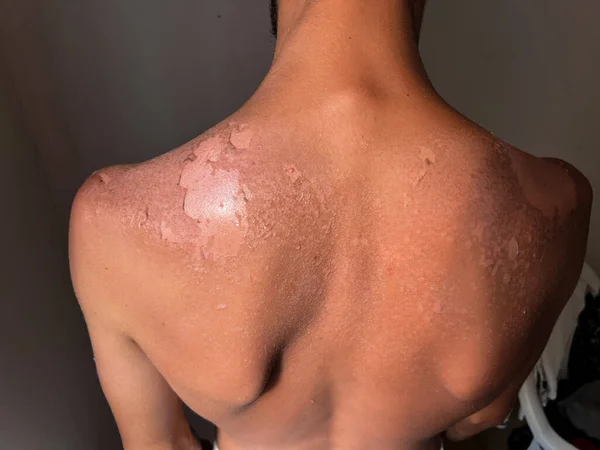 Peel back and shoulder skin from sunburn effect on young man body from sunbathing in summer