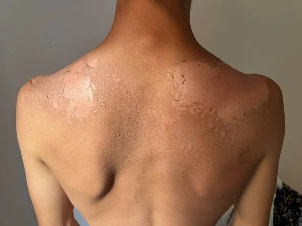 Peel back and shoulder skin from sunburn effect on young man body from sunbathing in summer