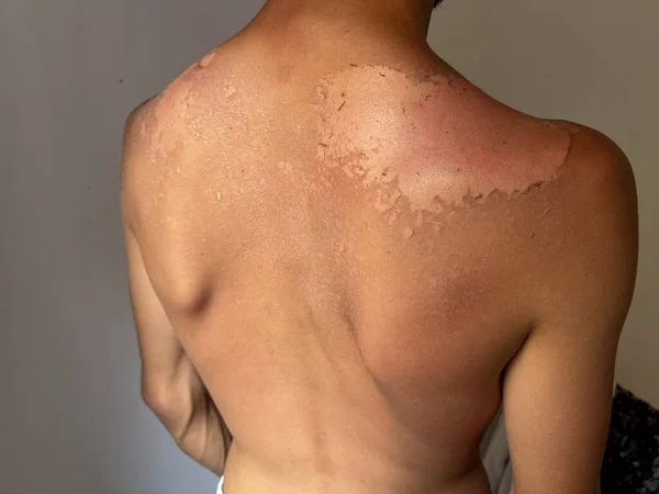 Peel Back Shoulder Skin Sunburn Effect Young Man Body Sunbathing — Φωτογραφία Αρχείου
