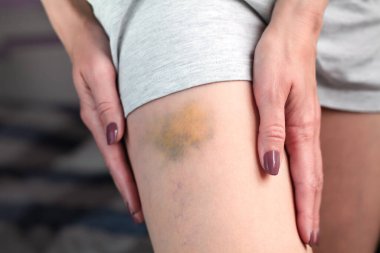 Bir kadının bacağında çürük var. Çürük bir bacak. Yakın plan..