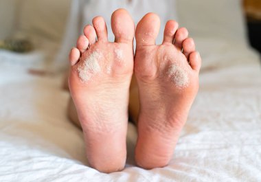 Ayak derisinde sorun var. Dermatolojik hastalıklar. Yakın plan..