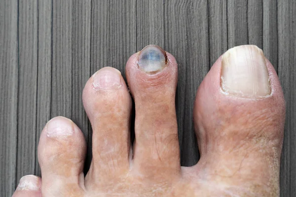 Siyah ayak tırnağı ayak parmağından soyuluyor ve küçük, dar ayakkabılar giydikten sonra kanıyor. Acıyı kapat. Tedavi için ameliyata ihtiyacım var..