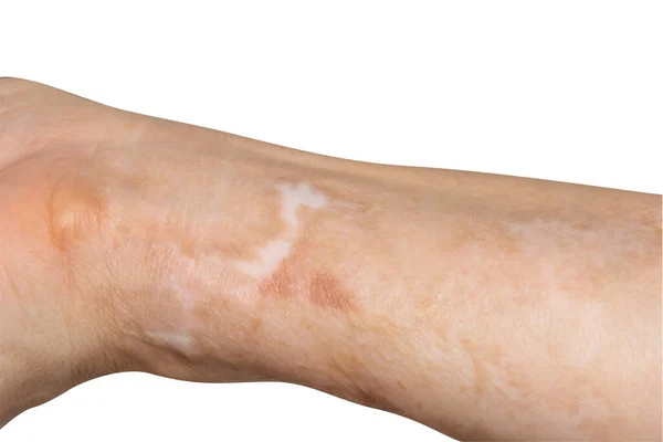 Scars Arms Caused Accident Hot Oil Splashed Arm Area — Stock Photo, Image