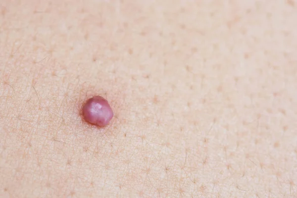 Skin tag is a polyp protruding from the skin.