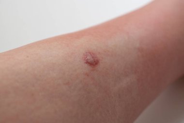 Sivrisinek ısırığıyla şişmiş bir kadının bacağı.