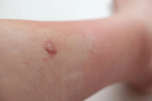Affected Area Woman Leg Blistered Gnat Bite — стоковое фото