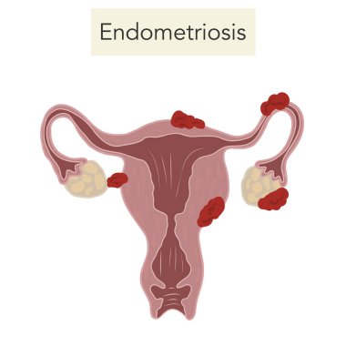 Endometriyozis hastalığı jinekoloji kadın ağrı leğeni 
