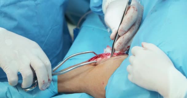 手術中に麻酔犬の背脚を操作している間、白い手袋と外科服で、男性獣医師の手を閉じる彼を支援女性アシスタントの手袋で手、 — ストック動画