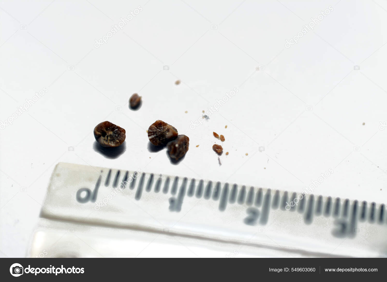 Nephrolithiasis Multiple Irregular Brown Kidney Stones Renal