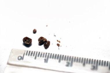 Nephrolithiasis, beyaz arka planda birden fazla düzensiz kahverengi böbrek taşı (renal calculi veya nephrolith), santimetre cinsinden çözünmüş ölçek, taşların büyüklüğü idrarda geçen milimetre cinsinden.
