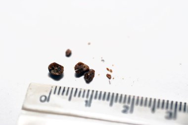 Nephrolithiasis, beyaz arka planda birden fazla düzensiz kahverengi böbrek taşı (renal calculi veya nephrolith), santimetre cinsinden çözünmüş ölçek, taşların büyüklüğü idrarda geçen milimetre cinsinden.
