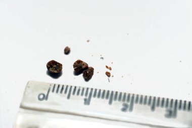 Nephrolithiasis, beyaz arka planda birden fazla düzensiz kahverengi böbrek taşı (renal calculi veya nephrolith), santimetre cinsinden çözünmüş ölçek, taşların büyüklüğü idrarda geçen milimetre cinsinden.