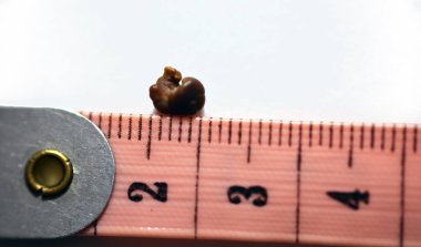 Beyaz arka plan üzerinde tek bir düzensiz kahverengi böbrek taşı (renal kalkülüs veya nephrolith), santimetre ölçekli taş, idrarda geçen yaklaşık 6 milimetre boyutunda.