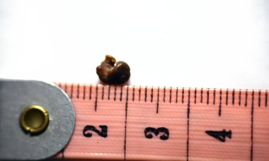 Beyaz arka plan üzerinde tek bir düzensiz kahverengi böbrek taşı (renal kalkülüs veya nephrolith), santimetre ölçekli taş, idrarda geçen yaklaşık 6 milimetre boyutunda.