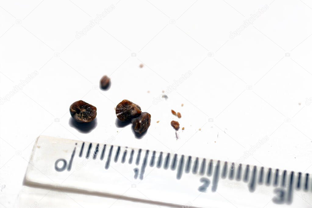 Nephrolithiasis, multiple irregular brown kidney stones (renal calculi or nephrolith) on white background, defocused scale in centimeters, the stones are millimeters in size that passed in urine