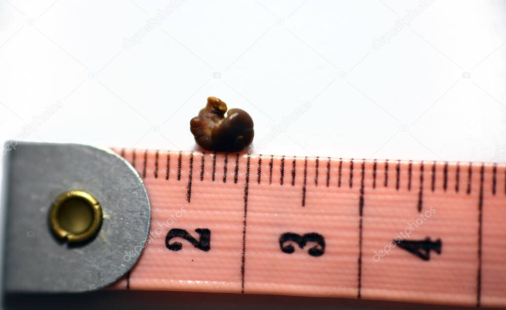 Nephrolithiasis, a single irregular brown kidney stone (renal calculus or nephrolith) on white background, scale in centimeters, the stone is around 6 millimeters in size that passed in urine