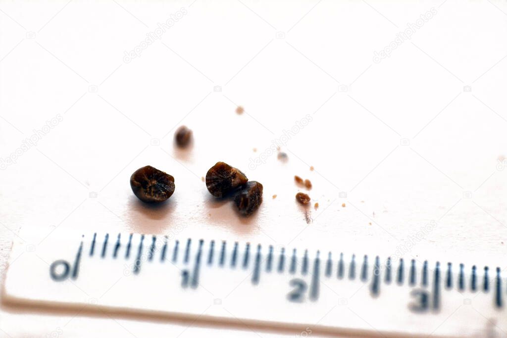Nephrolithiasis, multiple irregular brown kidney stones (renal calculi or nephrolith) on white background, defocused scale in centimeters, the stones are millimeters in size that passed in urine