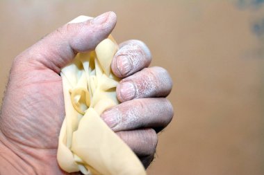 Mısır nişastası tozu ile insan elinin seçici odak noktası aşınmış bir tıbbi pudra eldiveninin derisine yapışıyor alerji ve aşırı duyarlılığa neden oluyor.