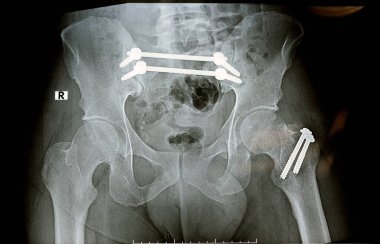 4 vida ve 2 çubukla sabitlenmiş kırık leğen kemiği ve 2 vidayla sabitlenmiş daha büyük kalça kemiği kırığı ve simfizis pubis kırığı, ileo-iliak pelvis fiksasyonu.