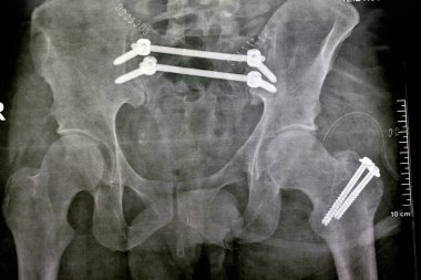 4 vida ve 2 çubukla sabitlenmiş kırık leğen kemiği ve 2 vidayla sabitlenmiş daha büyük kalça kemiği kırığı ve simfizis pubis kırığı, ileo-iliak pelvis fiksasyonu.
