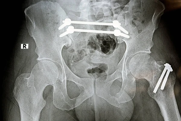 骨折骨盆用4个螺钉和2根杆子固定的平片X线片 股骨大转子用2个螺钉固定的骨折 合并耻骨骨折 睫状骨盆固定 — 图库照片
