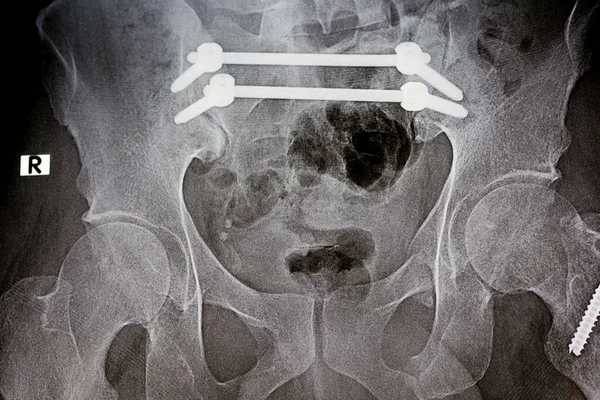 颅骨骨折骨盆用4个螺钉和2根螺杆固定的平面X线片 睫状骨骨盆固定 用螺钉固定骨盆 车祸后开放复位手术 — 图库照片