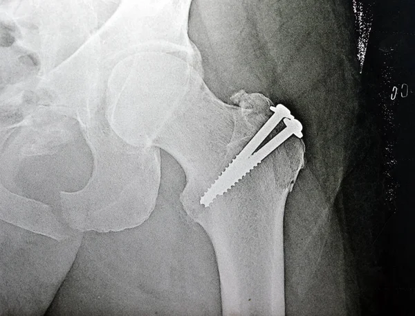 开窗复位手术中 左髋部平片X线与股骨大转子骨折 2个螺钉固定及意外合并耻骨骨折的选择性焦点 — 图库照片