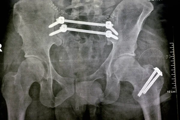 骨折骨盆用4个螺钉和2根杆子固定的平片X线片 股骨大转子用2个螺钉固定的骨折 合并耻骨骨折 睫状骨盆固定 — 图库照片