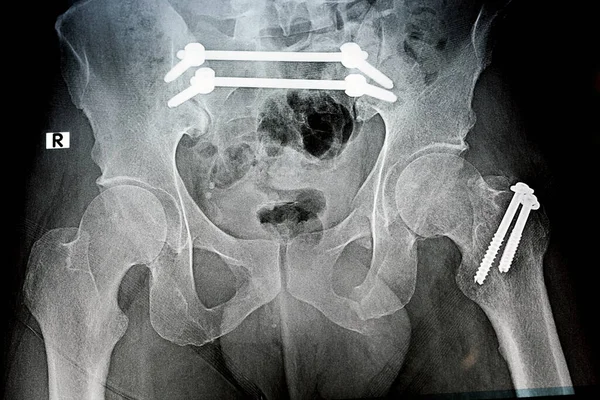 骨折骨盆用4个螺钉和2根杆子固定的平片X线片 股骨大转子用2个螺钉固定的骨折 合并耻骨骨折 睫状骨盆固定 — 图库照片
