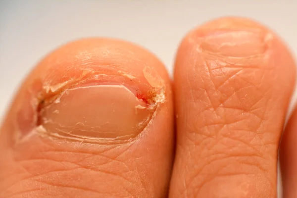 Ingrown toenail of the big toe of the right foot is a common condition in which the corner or side of a toenail grows into the soft flesh result in pain, inflamed skin, swelling and infection