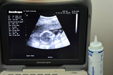 Kahire, Mısır, 24 Ocak 2018: Bir jinekoloğun doğum öncesi muayenesi sırasında 18 hafta 4 günlük hamile bir fetüsün başını gösteren taşınabilir ultrasonografinin bir monitörü.