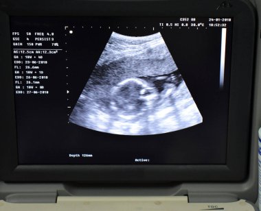 Taşınabilir ultrasonografinin bir monitörü gebelik yaşı GA olan bir fetüsün başını hamile bir kadının ultrason sonarı olan jinekoloğuyla hamilelik öncesi takip sırasında 18 hafta 4 gün gösteriyor.