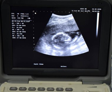 Taşınabilir ultrasonografinin bir monitörü gebelik yaşı GA olan bir fetüsün başını hamile bir kadının ultrason sonarı olan jinekoloğuyla hamilelik öncesi takip sırasında 18 hafta 4 gün gösteriyor.